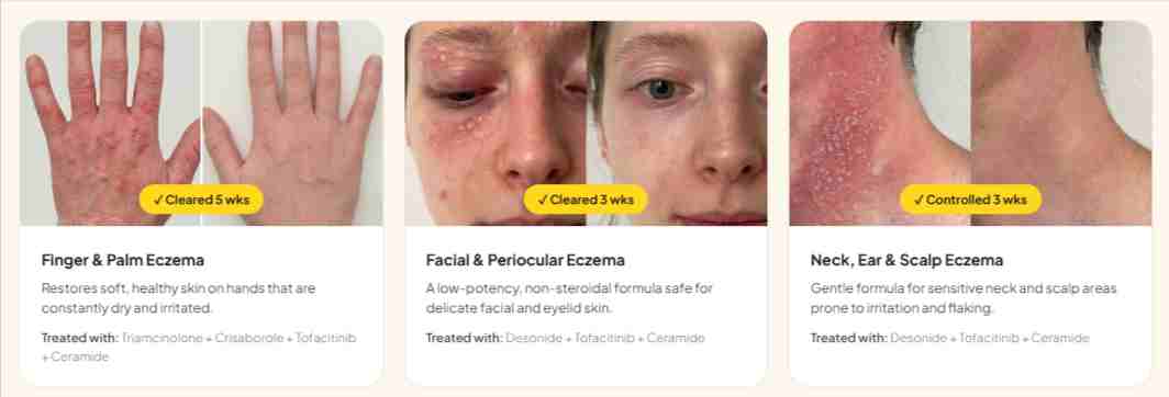 Curex Eczema Results